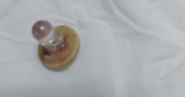 أطباء بنى سويف الجامعى يستخرجون لمبة من القصبة الهوائية لطفل.. صورة 
