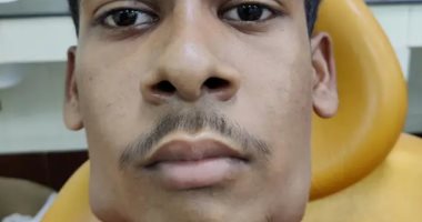 شاب هندى يخضع لجراحة لإزالة 82 سنًا من فمه بسبب ورم نادر.. صور