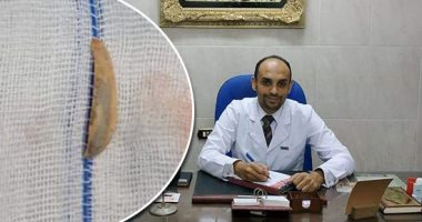 مفاجآت بغرف عمليات مستشفى بنها الجامعى.. استخراج دبوس تنجيد من صدر عامل.. وموبايل من بطن مريض ابتلعه 7 أشهر.. وسنة بالقصبة الهوائية لمسن ابتلعها بالخطأ.. ولمبة عربية وسوكت شاحن وقشرة لب بالقصبة الهوائية لأطفال
