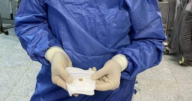 فريق جراحى ببنها الجامعى يستخرج حبة لب من القصبة الهوائية لطفل 3 سنوات