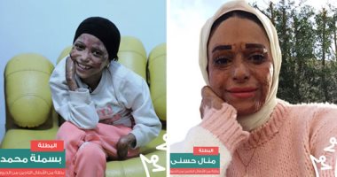 تحت رعاية الرئيس السيسى..قضية الحروق تشارك لأول مرة في فعاليات احتفالية "قادرون باختلاف"