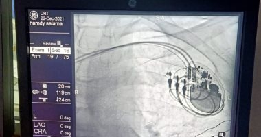 لأول مرة.. فريق طبى ببنها التعليمى يركب جهاز منظم ثلاثى الحجرات لمريض قلب