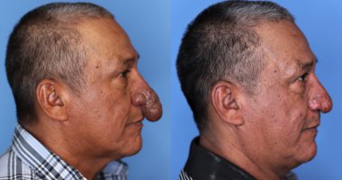 أمريكى يخضع لعملية تجميل لأنفه "الأغرب فى العالم".. "طوله وصل لشفتيه"