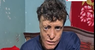 "بيقولوا عليا أبو رجل مسلوخة".. علاء حابس نفسه بالمنزل خوفا من التنمر (فيديو)