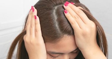وصفات طبيعية لعلاج قشرة الشعر فى المنزل.. عشان تلبسى غامق براحتك