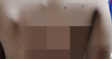 مرض نادر يصيب الطفل "عمار" ووالده يستغيث بالشرقية.. والتأمين الصحى يرد