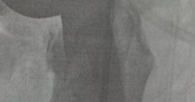 نجاح عملية تركيب نصف مفصل صناعى لمسن بمستشفى إدكو المركزى