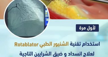 لأول مرة بالأقصر.. استخدام تقنية "الشنيور الطبى" فى توسيع الشرايين التاجية