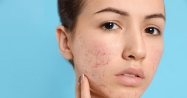 وصفات طبيعية لعلاج حب الشباب فى رمضان .. مكونات موجودة بمطبخك