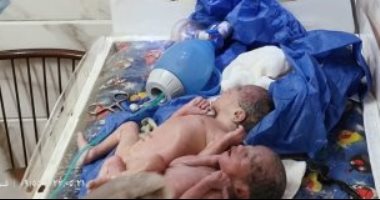 صحة الغربية: نقل أحد التوائم الـ5 من جهاز التنفس الصناعى لتحسن حالته
