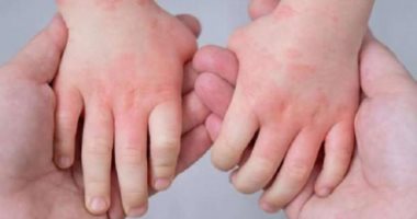 أنفلونزا الطماطم بعد ظهورها فى الهند.. 8 معلومات عنها