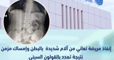 نجاح جديد فى مستشفى الكرنك بإنقاذ مريضة بتقنية "الليجا شور" فى الأقصر