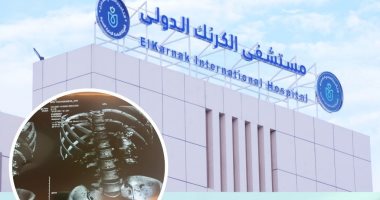 أطباء مستشفى الكرنك بالأقصر ينجحون فى استخراج حصوة "قرن الوعل" من كُلى مريض