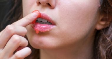 وصفات طبيعية لتقشير الشفاه وترطيبها.. زيت الجوز أبرزها