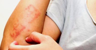 كيف تحمى نفسك من الإصابة بعدوى التهاب النسيج الخلوى؟