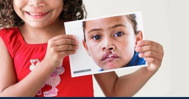 غدا.. "ابتسامتك أجمل" مبادرة للكشف عن الحروق والتشوهات والشفة الأرنبية بالأقصر