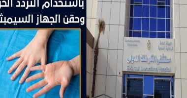 لأول مرة.. علاج فرط التعرق لفتاة باستخدام تقنية التردد الحراري بمستشفى الكرنك