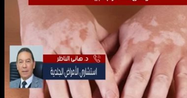 التجارب أثبتت فاعليته.. هانى الناظر يكشف تفاصيل علاج مرض البهاق.. فيديو