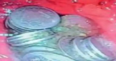 كان مكتئب شوية.. إزالة 63 قطعة معدنية من معدة رجل فى عملية استمرت يومين