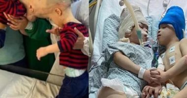 انفصال التوأم البرازيلى برناردو وآرثر بعد 9 عمليات منفصلة