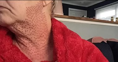 كان نفسها تبقى حلوة.. عملية تجميل فاشلة تحول مريضة إلى امرأة برقبة "سحلية"