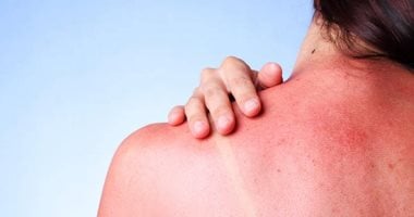 خل التفاح بديل لعلاج حروق الشمس.. اعرفى أهميته