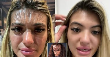 "وشها كرمش".. حروق الشمس تحول بريطانية إلى شبيهة الكلينجون فى Star Trek