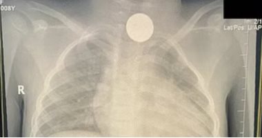 اكتشفوها بالصدفة.. استخراج عملة معدنية من حلق طفلة ظلت عالقة بالمرىء 4 أعوام