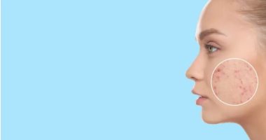 حبوب الخدين.. نصائح ذهبية للتخلص منها تمامًا دون رجعة