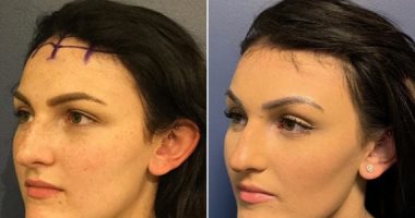 تصغير الجبهة أحدث تريندات التجميل على "التيك توك".. مش هتصدقى تكلفتها