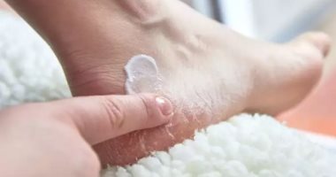 وصفات طبيعية لعلاج تشقق الكعبين.. مش هتحتاجى تشترى كريمات