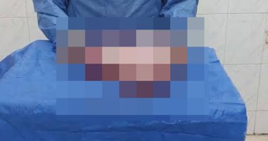 استئصال ورم ضخم من بطن طفلة بمركز أورام طنطا