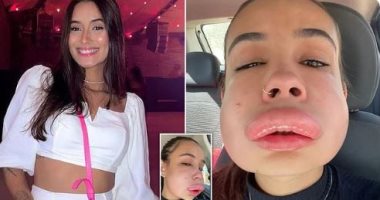 مشهد صادم لإصابة برازيلية بانتفاخ شديد فى وجهها بسبب حشو الفيلر.. فيديو وصور