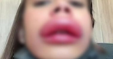 عملية تجميل فاشلة تشوه وجه فتاة برازيلية بشكل غريب.. صور