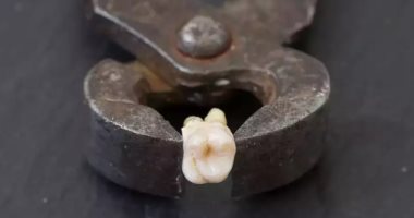 أمريكى يلجأ لخلع أسنانه بنفسه بعد فشله فى حجز موعد مع الطبيب لمدة 10سنوات