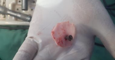 جراحة ناجحة لإخراج مسمار من رأس طفل داخل مستشفى جامعة أسوان.. صور
