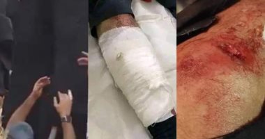 الأطقم الطبية الباكستانية تتمكن من استخراج الرصاصة من قدم عمران خان