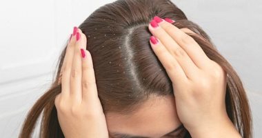 تخلصى من الإحراج نهائيا.. نصائح مهمة لعلاج قشرة الرأس بكل سهولة