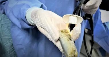 فريق طبى بمستشفى المنصورة الجامعى ينجح فى استخراج هاتف محمول من معدة شاب