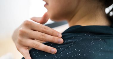 وصفات طبيعية لعلاج قشرة الرأس.. عشان تلبسى ألوان غامقة براحتك