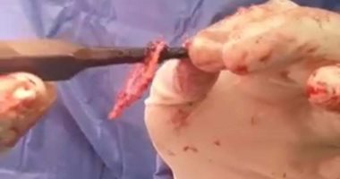 فريق طبي بمستشفى طوارئ المنصورة ينجح فى استخراج "مبرد حديدي" من رأس طفل.. صور