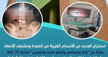 استخراج زلط وحديد ومسامير معدنية من معدة فتاة بمستشفى طيبة فى الأقصر