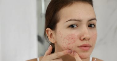وصفات طبيعية لعلاج ندبات البشرة.. للحصول على وجه خالٍ من العيوب