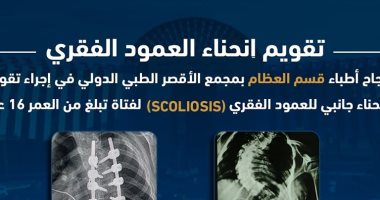 نجاح جراحة تقويم انحناء جانبى لعمود فقرى لفتاة 16 سنة بمجمع الأقصر الطبى الدولى
