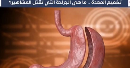 ما جراحة تكميم المعدة؟ ولماذا يتوفى البعض عند إجرائها؟