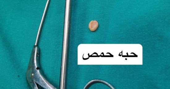 فريق جراحى بمستشفى الأطفال التخصصى يستخرج حبة حمص من القصبة الهوائية لطفلة