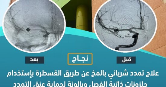 علاج تمدد شريانى بالمخ لمريضة 63 سنة بمستشفى طيبة التخصصى فى إسنا