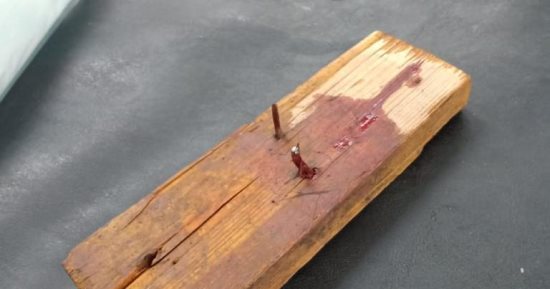فريق طبى بجامعة الزقازيق ينجح فى إنقاذ حياة طفل واستخراج خشبة من رأسه.. صور