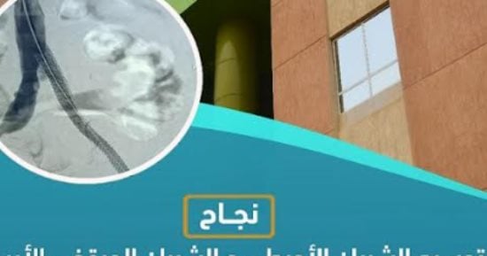 نجاح توسيع شريان أورطى وشريان حرقفى لمريض 66 سنة فى مستشفى طيبة بالأقصر