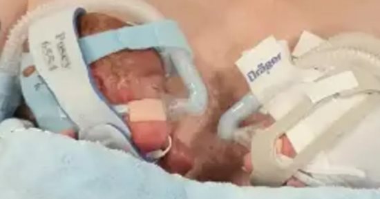 رضيعان بريطانيان كافحا للبقاء على قيد الحياة بعد ولادتهما فى الشهر السادس